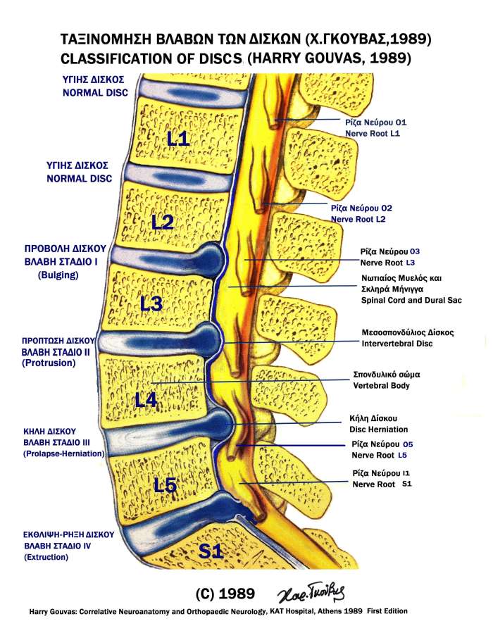 disc hernia classification by Gouvas