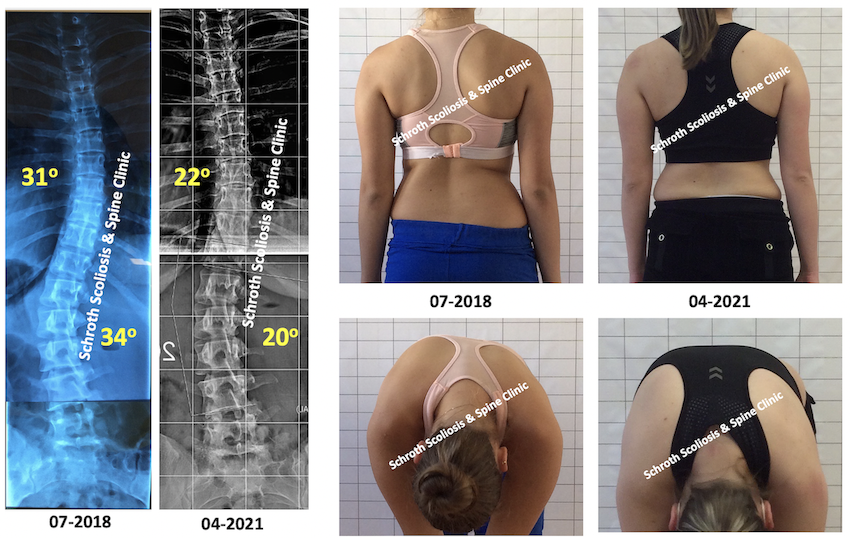 M.G. scoliosis treatment result schroth execises no brace Schroth Scoliosis Spine Clinic