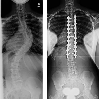 spinal fusion for adolescent idiopathic scoliosis