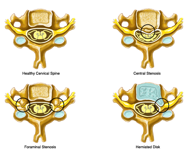 Spinal stenosis 