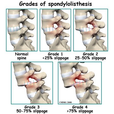 lumbar spondylolisthesis grades