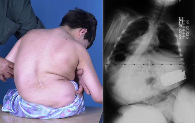 neuromuscular scoliosis cerebral palsy