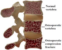 osteoporotic vertebra