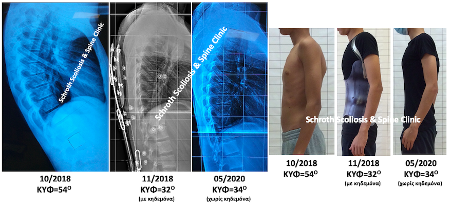 p.p.adolescent kyphosis treatment brace and exercises schroth scoliosis spine clinic