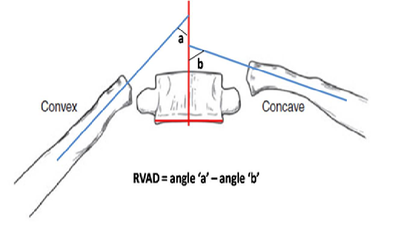 rib vertebra angle difference