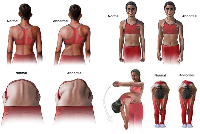 adams test for scoliosis