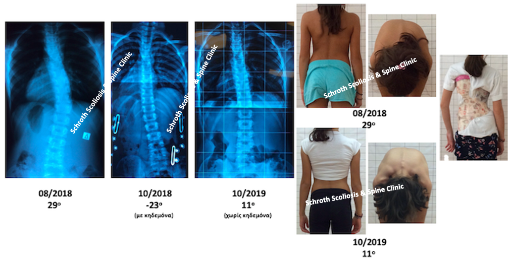 Εξαιρετική διόρθωση της σκολίωσης με συνδυασμό κηδεμόνα και ασκήσεων Schroth μέσα σε 1 χρόνο, από τις 29 στις 11 μοίρες. K.V. brace and schroth treatment improvement schroth scoliosis spine clinic