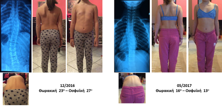Lakafosi Schroth exercises improvement