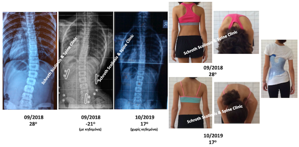 Σημαντική διόρθωση της σκολίωσης σε ασθενή 10 ετών, με κηδεμόνα και ασκήσεις Schroth, από τις 28 στις 17 μοίρες, μετά από μόλις 13 μήνες θεραπείας M.C. brace and Schroth treatment improvement schroth scoliosis spine clinic