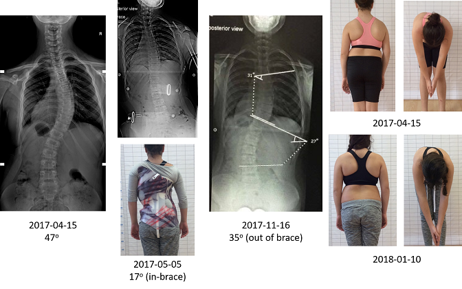 Orfanidi RSC brace Schroth BSPTS scoliosis treatment result