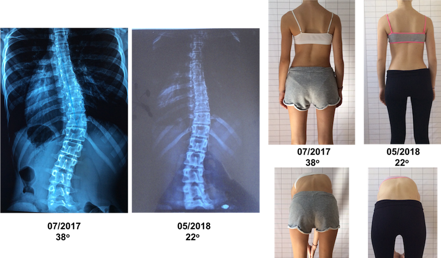 Prevezanou Schroth BSPTS exercises improvement