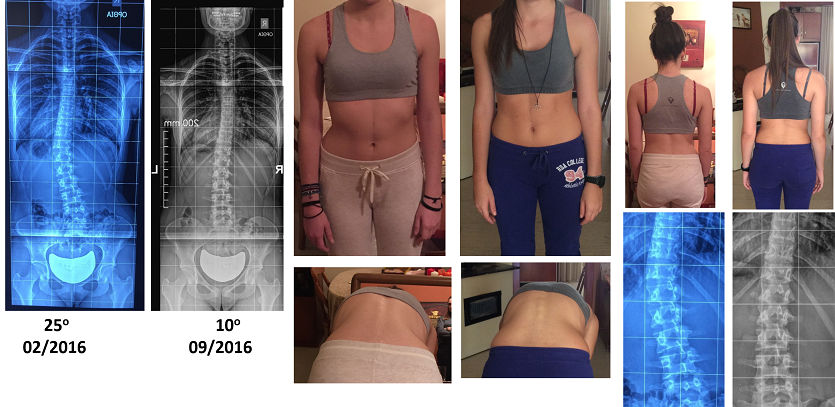 Soumpasi photos Schroth