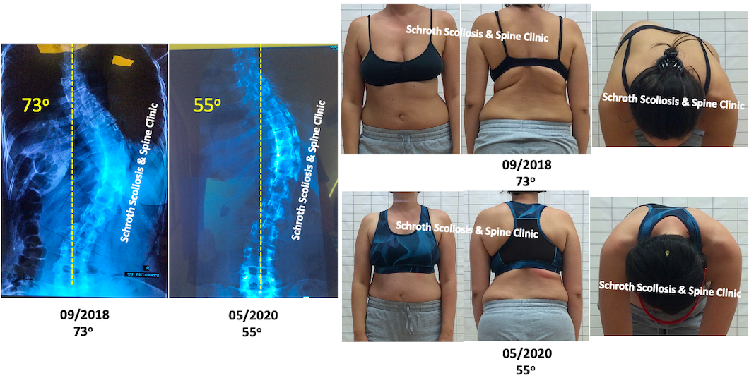 k.a. adult severe scoliosis treatment Schroth Scoliosis Spine Clinic