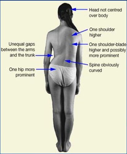 scoliotic posture