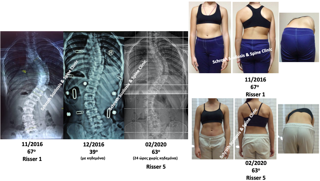 Εξαιρετικό θεραπευτικό αποτέλεσμα σε νεαρή ασθενή με μεγάλη σκολίωση, εφαρμόζοντας κηδεμόνα και ασκήσεις Schroth στην Schroth Scoliosis & Spine Clinic. Η γωνία της σκολίωσης μειώθηκε από τις 67 στις 63 μοίρες, ενώ ταυτόχρονα υπήρχε σημαντική κλινική βελτίωση στην συμμετρία του σώματος και στην στροφή του κορμού. D.S.severe scoliosis treatment bracepsse schroth scoliosis spine clinic