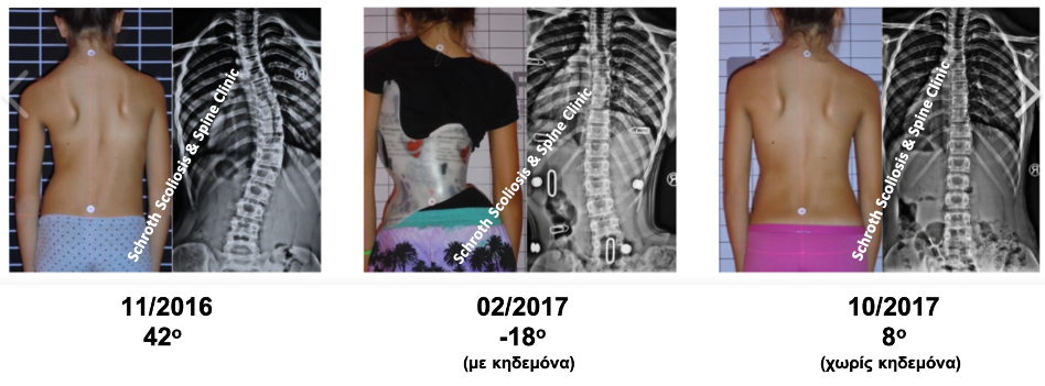 Πολύ σημαντική βελτίωση της σκολίωσης με κηδεμόνα και ασκήσεις Schroth, από τις 42 μοίρες στις 8 μοίρες μέσα σε έναν χρόνο. Επίσης υπάρχει πάρα πολύ μεγάλη βελτίωση και στην στροφή των σπονδύλων αλλά και στην συμμετρία του σώματος της ασθενούς. I.E. brace and Schroth scoliosis treatment schroth scoliosis spine clinic
