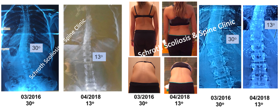 M.E. photos Schroth BSPTS improvement Schroth Scoliosis Spine Clinic