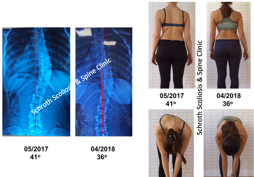 M.I. photos Schroth BSPTS improvement Schroth Scoliosis Spine Clinic