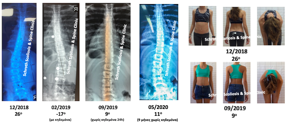 Σημαντική διόρθωση της σκολίωσης, μέσα σε 9 μήνες, εφαρμόζοντας κηδεμόνα και ασκήσεις με την μέθοδο Schroth. Από τις 26 μοίρες η σκολίωση διορθώθηκε στις 9 μοίρες και το παιδί σταμάτησε να φοράει τον κηδεμόνα του συνεχίζοντας μόνο ασκήσεις Schroth. Σχεδόν 1 χρόνο μετά, κάνοντας μόνο ασκήσεις, χωρίς κηδεμόνα, η σκολίωση της είναι σταθερή στις 11 μοίρες. N.K. brace and Schroth scoliosis treatment schroth scoliosis spine clinic