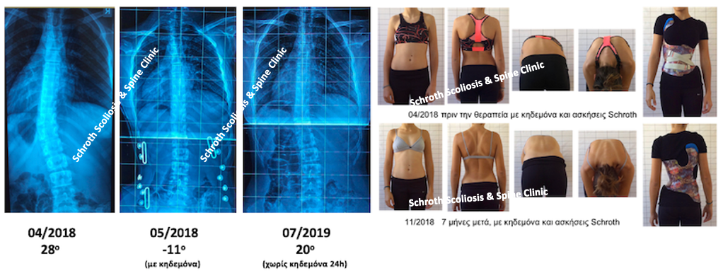 Σημαντική διόρθωση της σκολίωσης μέσα σε 1 χρόνο με κηδεμόνα και ασκήσεις Schroth. Από τις 28 στις 20 μοίρες, με ταυτόχρονη εντυπωσιακή βελτίωση στην συμμετρία του σώματος και στην στροφή του κορμού. N.L. brace Schroth scoliosis treatment schroth scoliosis spine clinic