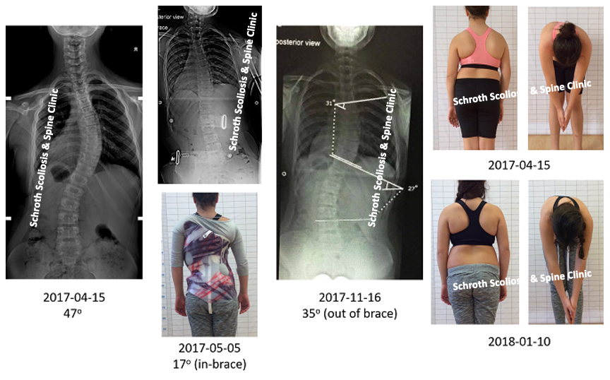 Μεγάλη ακτινολογική και κλινική βελτίωση της σκολίωσης με κηδεμόνα και ασκήσεις Schroth, από τις 47 στις 35 μοίρες. O.Z. RSC brace Schroth BSPTS scoliosis treatment result schroth scoliosis spine clinic