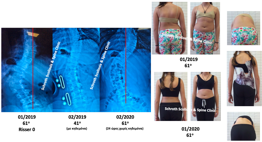 Εξαιρετικό θεραπευτικό αποτέλεσμα σε νεαρή ασθενή με πολύ μεγάλη σκολίωση 61 μοιρών και μεγάλο υπόλοιπο ανάπτυξης (χωρίς περίοδο στην έναρξη θεραπείας). Εφάρμοσε κηδεμόνα και Ειδικές Ασκήσεις Schroth και κατάφερε να σταθεροποιήσει την σκολίωση της και να βελτιώσει σημαντικά την συμμετρία στο σώμα της και την στροφή του κορμού. Αρχικά όλοι οι ορθοπεδικοί της είχαν προτείνει μόνο χειρουργική αντιμετώπιση, καμία άλλη επιλογή. P.D. severe scoliosis treatment bracepsse schroth scoliosis spine clinic