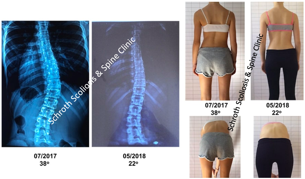 P.E. Schroth BSPTS exercises improvement Schroth Scoliosis Spine Clinic