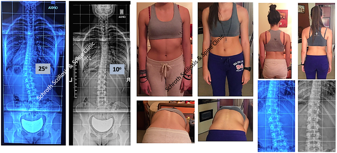 S.A. Schroth BSPTS exercises scoliosis treatment Schroth Scoliosis Spine Clinic