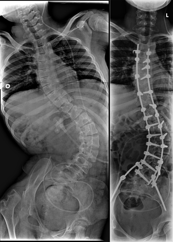 neuromuscular scoliosis spinal fusion