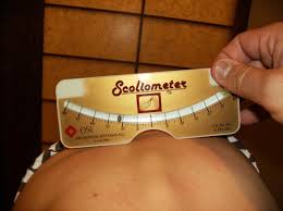 Μέτρηση της στροφής της σκολίωσης με το σκολιώμετρο κατά το τέστ επίκυψης (Adam's test) scoliometer