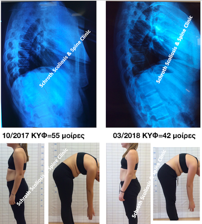 Σημαντική ακτινολογική διόρθωση της κύφωσης σε νεαρή κοπέλα, από τις 55 στις 42 μοίρες. Η στάση το σώματος της επίσης βελτιώθηκε σε μεγάλο βαθμό A.A. kyphosis improvement schroth scoliosis spine clinic