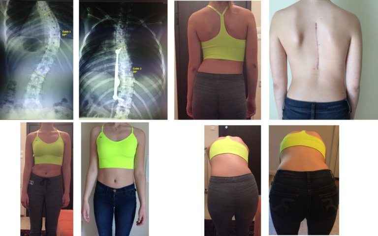 ApiFix + Schroth method treatment result