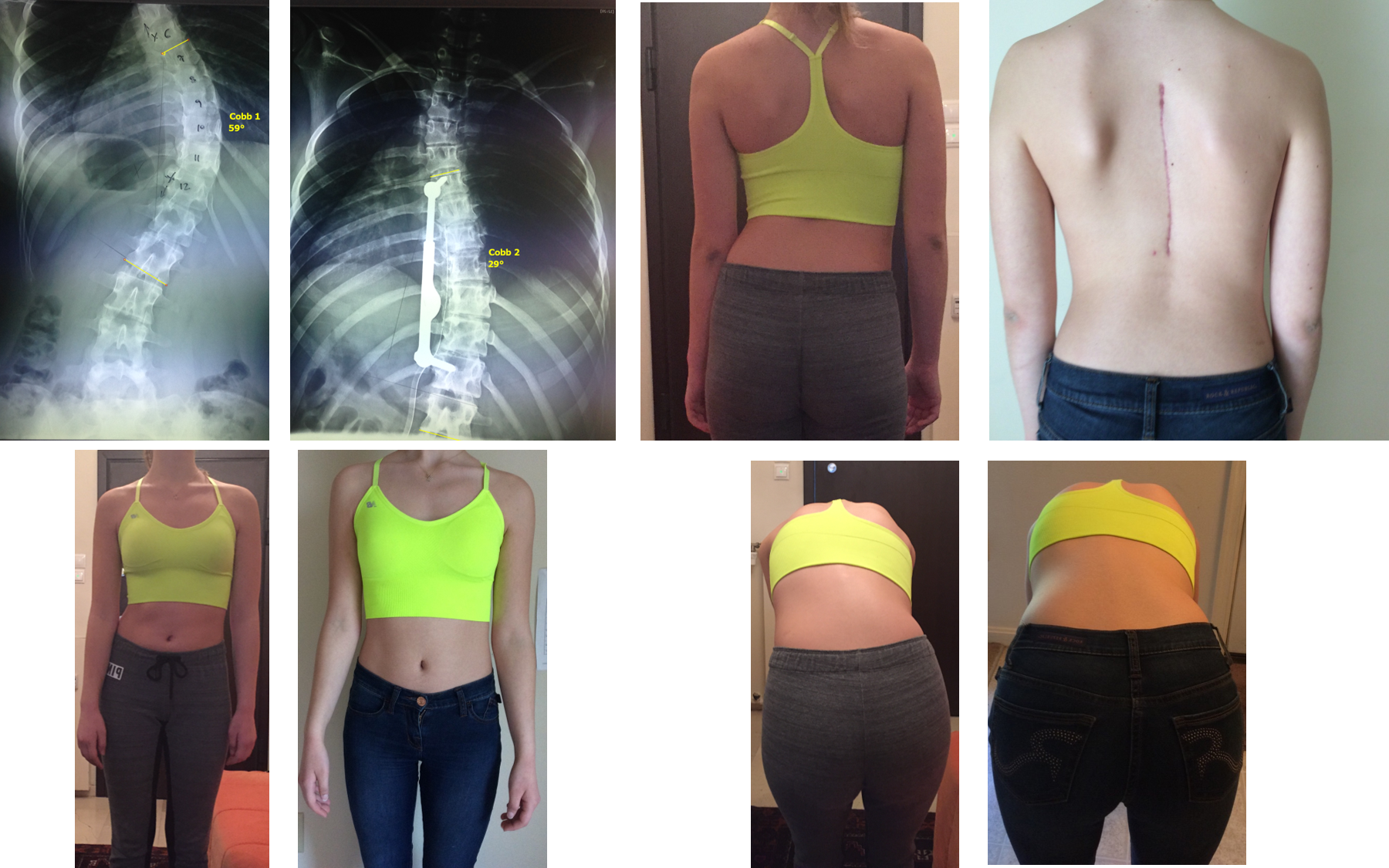 Εξαιρετικό αποτέλεσμα (ακτινολογικά και κλινικά) 3 μήνες μετά την εφαρμογή των ασκήσεων της μεθόδου Schroth σε ασθενή με καλή ένδειξη για το σύστημα ApiFix ApiFix + Schroth method treatment result