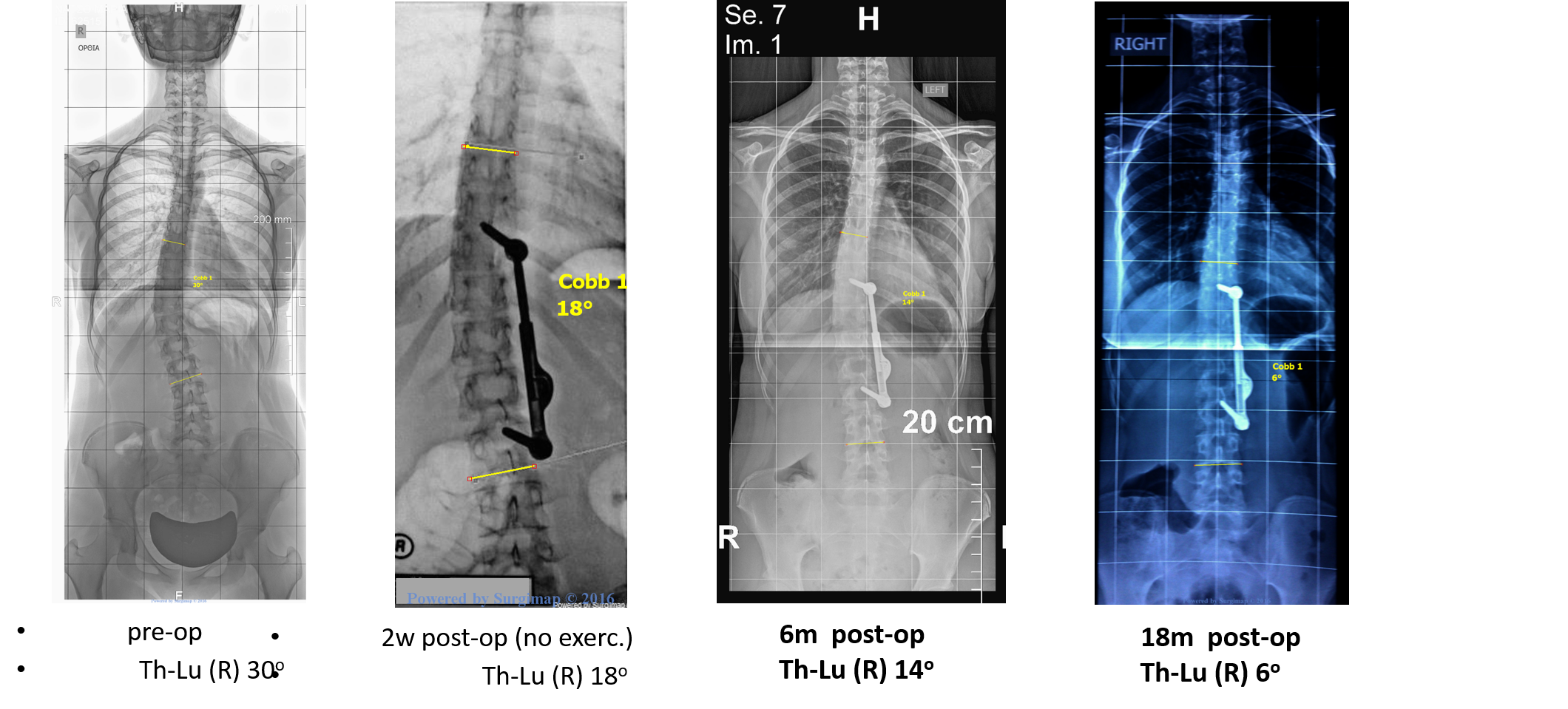 Διόρθωση 12 επιπλέον μοιρών με τις ασκήσεις της μεθόδου Schroth μετά την επέμβαση με το σύστημα ApiFix. Οι ασκήσεις της μεθόδου Schroth πρέπει πάντα να εφαρμόζονται μετά την τοποθέτηση του μηχανισμού για να βελτιώσουν περαιτέρω την σκολίωση ApiFix + Schroth method improvement after exercises