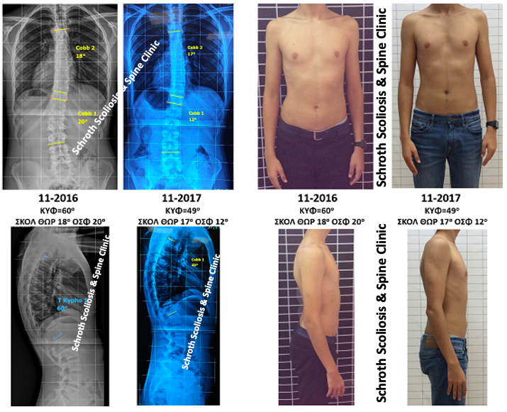 Πολύ σημαντική βελτίωση της κύφωσης από τις 60 στις 49 μοίρες, μέσα σε 12 μήνες, κατά την μέγιστη φάση ανάπτυξης του παιδιού. Σημαντικά βελτιώθηκε και η σκολίωση, από τις 20 στις 12 μοίρες, όπως και η συνολικότερη στάση σώματος του παιδιού. Έτσι, αποφεύχθηκε η εφαρμογή κηδεμόνα, που ήταν η αρχική σύσταση του γιατρού του. D.D. Schroth exercises scoliosis kyphosis improvement schroth scoliosis spine clinic