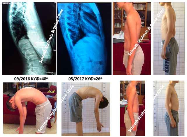 Σημαντική βελτίωση της κύφωσης σε νεαρό άτομο μέσα σε μερικούς μήνες, κάνοντας μόνο ασκήσεις με την μέθοδο Schroth. Από τις 48 μοίρες στις 26 μοίρες (χωρίς κηδεμόνα). Η σύσταση του γιατρού αρχικά ήταν να φορέσει κηδεμόνα για 22 ώρες την ημέρα. Η κύφωση διορθώθηκε, η στάση του παιδιού βελτιώθηκε σημαντικά και δεν χρειάστηκε να εφαρμοστεί κηδεμόνας. E.E. kyphosis improvement schroth exercises schroth scoliosis spine clinic