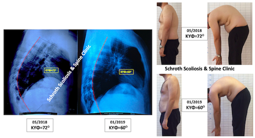 Πολύ σημαντική διόρθωση της Κύφωσης Scheuermann σε ενήλικο ασθενή, από τις 72 στις 60 μοίρες. Σημαντική βελτίωση υπήρξε και στην στάση του σώματος και στους πόνους που είχε ο ασθενής. M.E. kyphosis correction Schroth exercises Schroth Scoliosis Spine Clinic