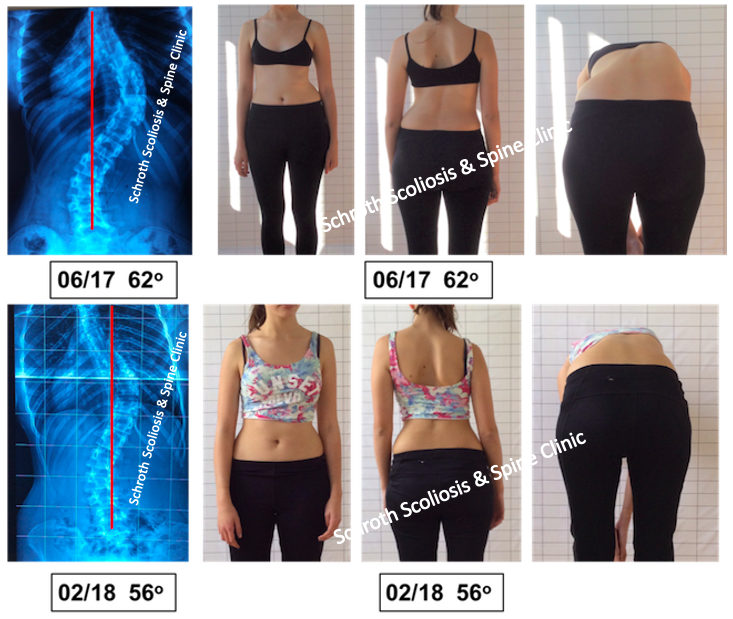 M.N. scoliosis improvement Schroth Scoliosis Spine Clinic