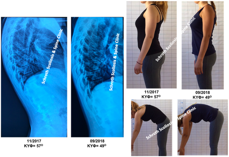 Σημαντική κλινική και ακτινολογική βελτίωση σε κύφωση ενηλίκου μέσα σε 10 μήνες. Η ασθενής ενώ παρουσιάστηκε στο κέντρο μας με σημαντικές ενοχλήσεις στην πλάτη, τώρα είναι πλήρως ασυμπτωματική, ενώ η στάση του σώματος της έχει βελτιώθει σημαντικά. N.K. kyphosis improvement schroth seas exercises Schroth scoliosis spine clinic