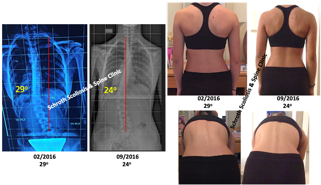 N.K.adolescent scoliosis Cobb angle and posture correction Schroth Scoliosis Spine Clinic