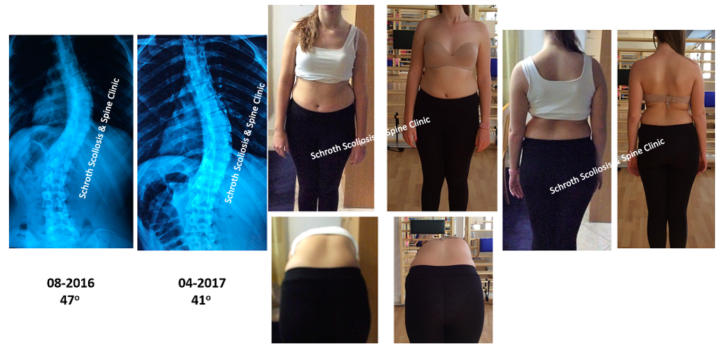 Σημαντική διόρθωση της σκολίωσης σε νεαρή ασθενή στην Schroth Scoliosis & Spine Clinic, από τις 47 στις 41 μοίρες, εφαρμόζοντας μόνο ασκήσεις Schroth P.M. ApiFix preop Schroth treatment result Schroth Scoliosis Spine Clinic