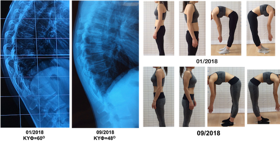 Πολύ μεγάλη βελτίωση σε ενήλικη ασθενή με Κύφωση, από τις 60 στις 48 μοίρες, εφαρμόζοντας μόνο ασκήσεις με τις μεθόδους Schroth και SEAS. Voultsou kyphosis correction schroth