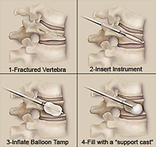 balloon kyphoplasty