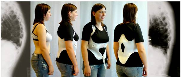 Κηδεμόνας Kyphologic (by Dr.Weiss) για κύφωση τύπου Scheuermann με πολύ καλό διορθωτικό αποτέλεσμα kyphologic brace