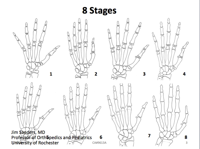 Η κλίμακα Tanner Whitehouse III για τον υπολογισμό της οστικής ανάπτυξης με ακτινογραφία στο αριστερό χέρι skeletal maturity hand xray