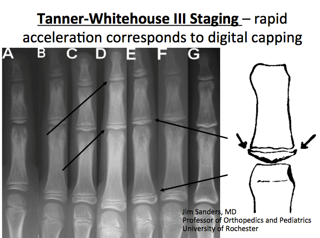 Η κλίμακα Tanner Whitehouse III για τον υπολογισμό της οστικής ανάπτυξης με ακτινογραφία στο αριστερό χέρι skeletal maturity hand xray