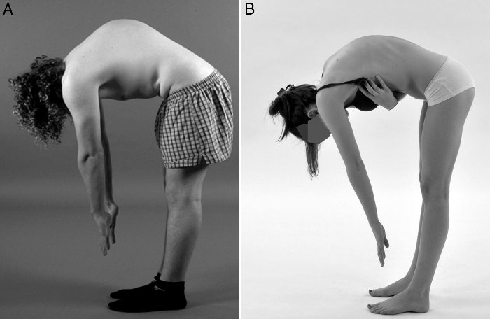 Στην εικόνα Α έχουμε κύφωση τύπου Scheuermann και στην εικόνα Β λειτουργική κύφωση differential diagnosis postural and scheuermann kyphosis