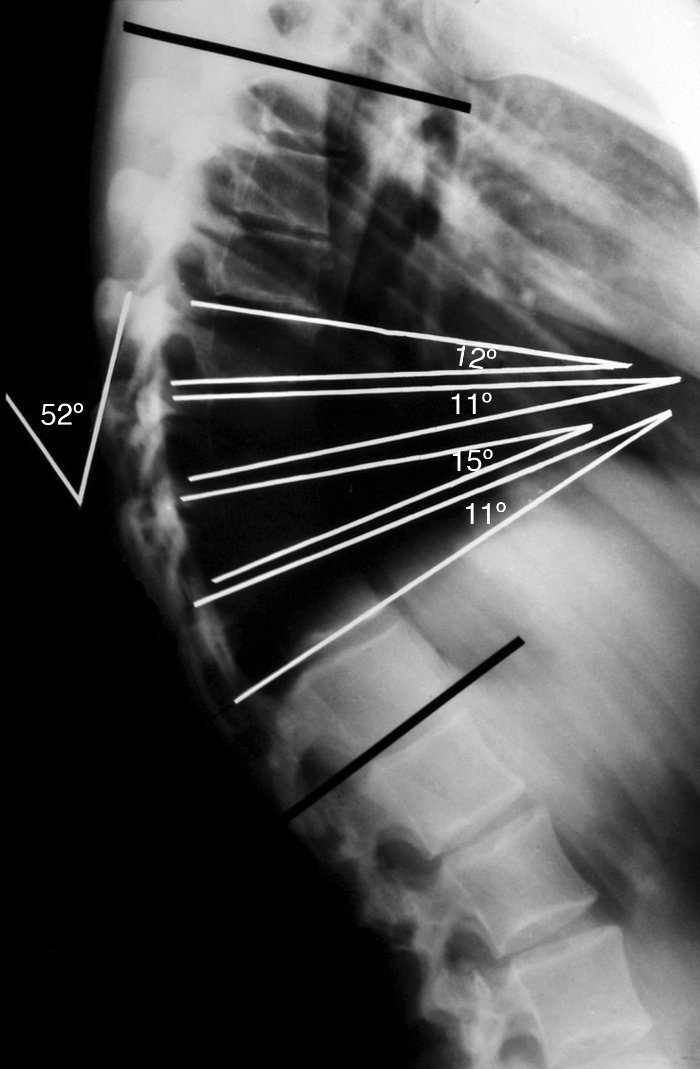 Μέτρηση της σφηνοειδούς παραμόρφωσης των σπονδύλων για τον προσδιορισμό της ύπαρξης ευρημάτων Scheuermann σε ακτινογραφία measuring scheuermann wedging