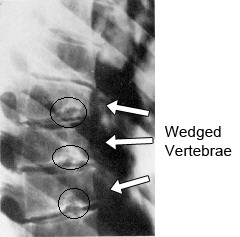 Σφηνοειδής παραμόρφωση των σπονδύλων στην κύφωση τύπoυ Scheuermann. Στους κύκλους εικονίζονται οι όζοι του Schmorl scheuermann wedging and schmorl nodes