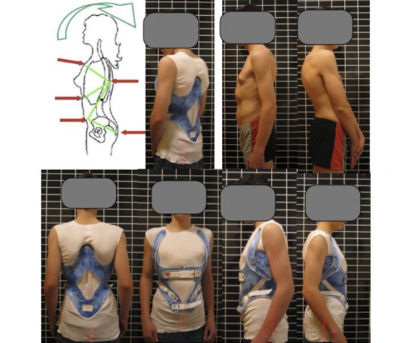 Κηδεμόνας Rigo-Cheneau (by Dr. Rigo) για την κύφωση τύπου Scheuermann Rigo-cheneau brace for kyphosis